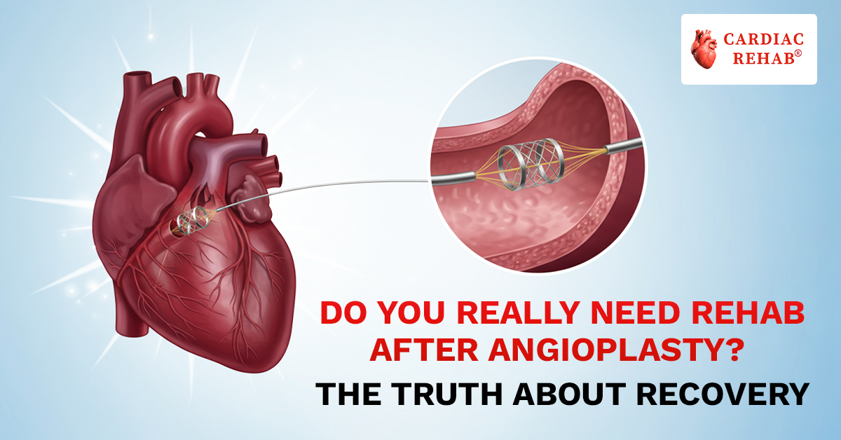 Do You Really Need Rehab After Angioplasty? – The Truth About Recovery
